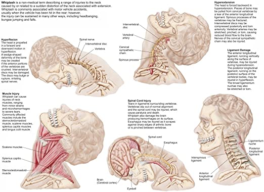 Whiplash And Other Soft Tissue Injuries